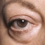 目の下のたるみ　予防