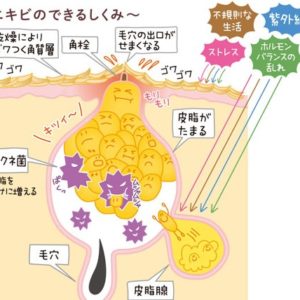 ニキビの原因は皮脂分泌、毛穴のつまり、アクネ菌の影響