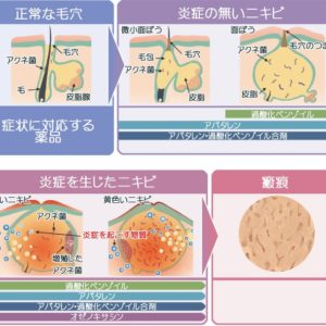 ニキビは思春期から青年期にかけてよく見られる発疹