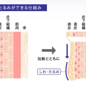 美しさを保つためには！加齢によるたるみ対策の重要性