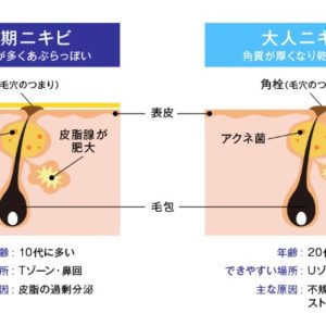 ニキビに悩んで外出が億劫…正しい対処法とは？